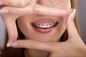 10 Braces and Aligner Tips for Everyday Success
